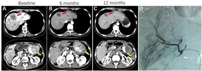 Hepatic Artery Infusion of Floxuridine in Combination With Systemic Chemotherapy for Pancreatic Cancer Liver Metastasis: A Propensity Score-Matched Analysis in Two Centers